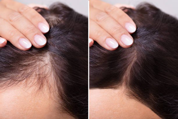 Hair Fall Control Treatment
